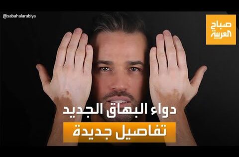 صباح العربية| كل ما تريد معرفته عن الدواء المنزلي الجديد لعلاج البهاق