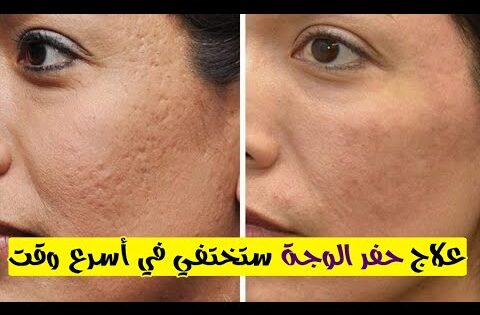علاج حفر الوجة ١٣ طريقة نتيجتها خلال أسبوعين فقط ستختفي الحفر