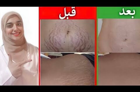 وصفة لعلاج الخطوط الحمراء والبيضاء في الجسم نهائيا