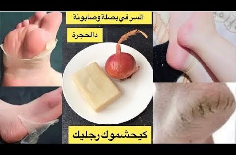 مسحة واحدة وتخلصي من تشققات القدمين حتي لوكانت شديدة علاج تشقق وخشونة الأرجل بخطوات سهلة لن تظهرأبدا