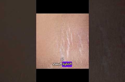 علاج سحري لعلامات التمدد البيضاء 🥇- دكتور يوسف