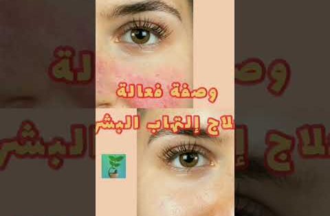 علاج إلتهاب البشرة