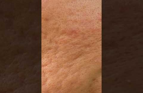 علاج آثار و ندبات حب الشباب ج١ #shorts