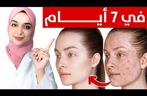 علاج حبوب الوجه و الجسم في أسبوع /حب الشباب و علاجه السريع و الاقتصادى